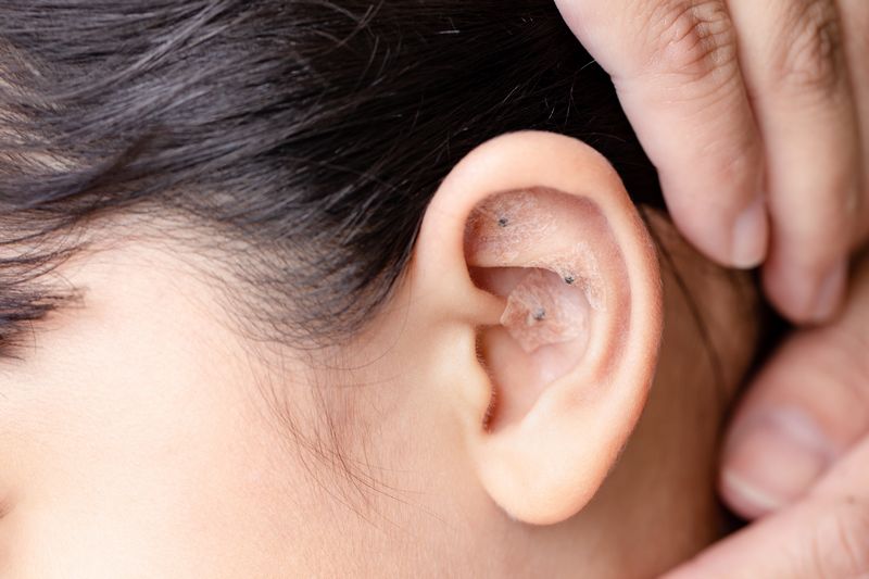 Close de sementes de auriculoterapia aplicadas com micropore, ilustrando o método natural e não invasivo.